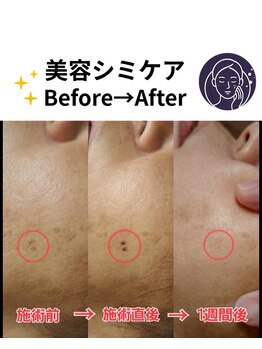 ヒカリ(Hikari)/ビフォーアフター