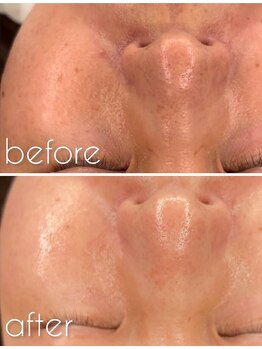 クーレ(CURE)/最強肌改善プラズマジェット