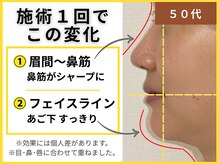 ブプラ 別府店(BUPURA)/50代の気になるラインに！小顔術