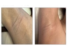 クリア 麻布十番(CLEAR)/薄着の前にワキ脱毛&黒ずみ改善