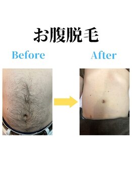 ヒゲマスター 三島店/お腹脱毛