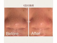 メナードフェイシャルサロン 片町店/毛穴黒ずみケア