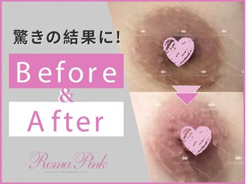 ドクタービセア 池袋店(DR.VISEA)の写真/【超最新フェムケア☆ローマピンク】バストトップ/VIO/唇などのくすみ・黒ずみを改善！肌本来のピンク色に
