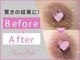ドクタービセア 池袋店(DR.VISEA)の写真/【超最新フェムケア☆ローマピンク】バストトップ/VIO/唇などのくすみ・黒ずみを改善！肌本来のピンク色に