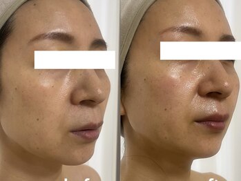 ブルーム(BLOOM)/最先端エステ機器　WISH PRO