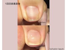 巻き爪のお悩みご相談ください