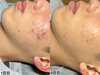 ハーブピーリング×韓国肌管理【&me福岡天神店】ピーリング/ララピール毛穴ニキビケア/ハーブピーリング【ニキビケア】