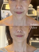 ルミライ(Lumirai)/ 痛少なく心地よくリフトアップ