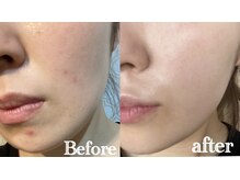 ジャミーラ(JAMIL)/◇幹細胞スキンケアビフォアフ