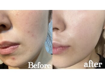 ジャミーラ(JAMIL)/◇幹細胞スキンケアビフォアフ