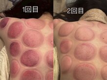 骨気(コルギ)専門店 YONG miu【ヨング ミュー】/カッピング【before after】