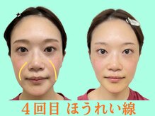 ナチュラルパーフェクトフェイス 新宿/4回目ほうれい線も解消/新宿小顔