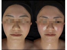 侘寂(wabisabi)/症例写真