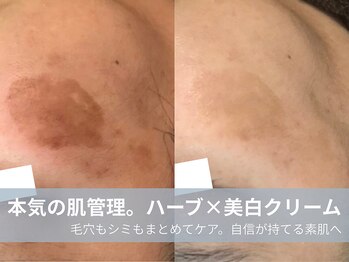 ラシック 加古川店(La chic.)の写真/ハーブで頑固なシミを狙い撃ち美肌育成×最新プラズマでシワに潤い注入！欲張りＷエイジングケア★