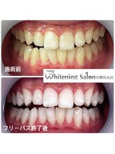 ホワイトニングサロン 京都烏丸店/ホワイトニング施術例