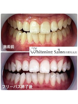 ホワイトニングサロン 京都烏丸店/ホワイトニング施術例