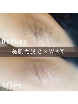 エピナ 横浜店(Epina)/脇MIX脱毛☆