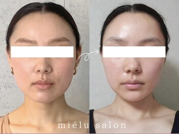 ミエル(mielu)/mielu式小顔矯正