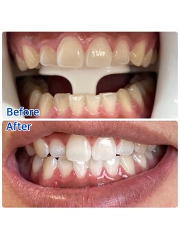 実夢(miyu)/美容ジェル・ビフォーアフター