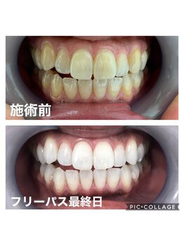 ホワイトニングサロン 京都烏丸店/ホワイトニング施術例