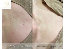 サロン ヴィーナス(VENUS)/剥けるハーブピーリング胸の例