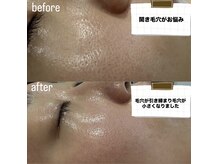 ルミエール パークサイド(L’MIERE parkside)の雰囲気（30代後半開き毛穴で来店。施術10回で毛穴が引き締まりました）