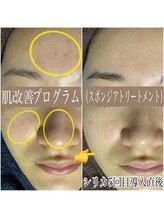 エステルーム クリスタル/【肌改善プログラム】ピーリング