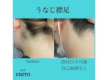 アクト クロ(ACT curro)/【うなじ襟足】脱毛施術例