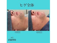 アクト クロ(ACT curro)/【ヒゲ全体】脱毛施術例