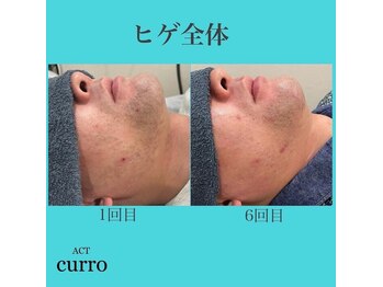 アクト クロ(ACT curro)/【ヒゲ全体】脱毛施術例