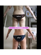 新百合ケ丘の痩身専門エステサロン リリバ(ririva)/下半身セルライト改善引き締め