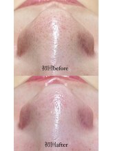 クレヴィー(Creviy)/韓国式3D毛穴洗浄(初回1回目)