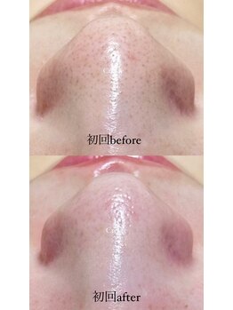 クレヴィー(Creviy)/韓国式3D毛穴洗浄(初回1回目)