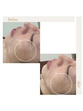 アイ アンド ネイル(Eye＆Nail Day)/【アクネ菌・毛穴ケア】