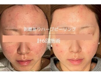 ライフサロン 別府(Life Salon)/ハーブピーリング/ララピール