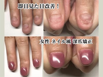 ネイル風 深爪矯正