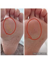 遊歩堂/ヒールダコに魚の目