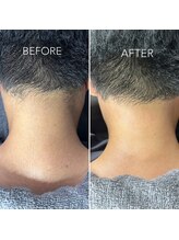 ビオトーン バイ ツリー(biotone by TREE)/男性/うなじ/Wax脱毛