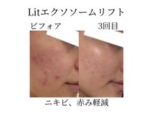 フラワー(FLOWER)/Lit3回目　ニキビ　赤み改善