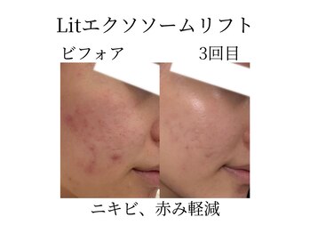フラワー(FLOWER)/Lit3回目　ニキビ　赤み改善