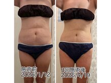 クールスパ(COOL SPA)/40代女性 お腹症例