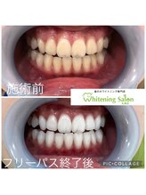ホワイトニングサロン 札幌店/【ホワイトニング】#札幌#大通り