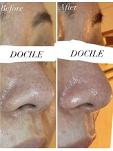 ドシル(DOCILE)/黒ずみがなくなってます！