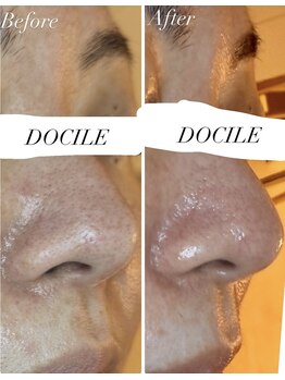 ドシル(DOCILE)/黒ずみがなくなってます！