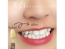 ホワイトニングbefore after
