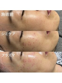 ルミナ シブヤ(LUMINA SHIBUYA)/プラズマ＋シミケア1回