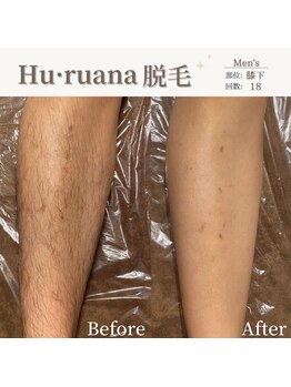 フルアナ(Hu ruana)/脱毛