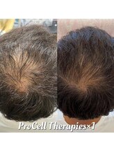 アイスブルー(Ice blue)/プロセルセラピーズBefore/After