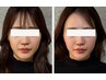 【小顔調整モニター募集】小顔調整30分→