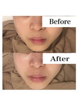 ライム 天神(LIME)/before&afterトーンアップで色白